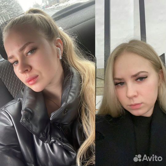 Углы Джоли/ коррекция скул