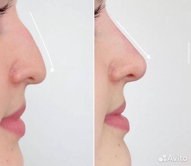 Ринопластика