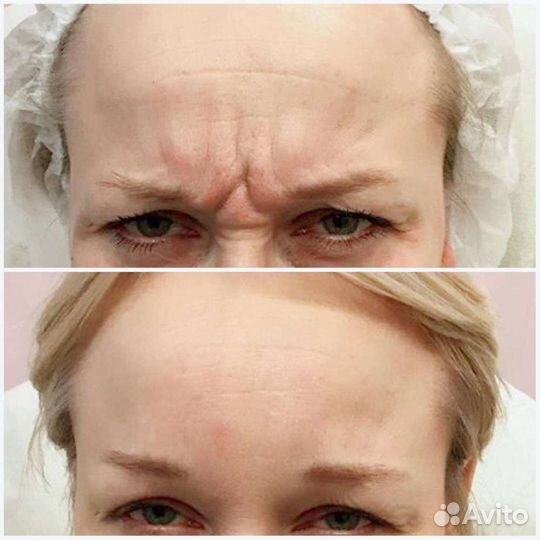 Ботокс верхняя треть