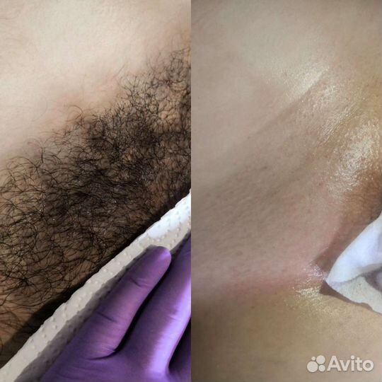 Депиляция воском, сахаром