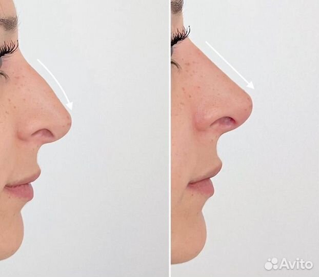 Ринопластика