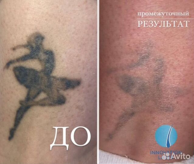 Лазерное удаление татуировок