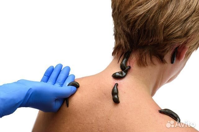 Купон на сеанс Гирудотерапии/ Косметологии