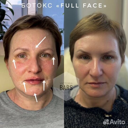 Ботокс для лица / Косметолог