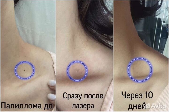 Удаление папиллом,родинок,бородавок