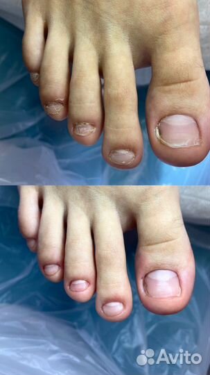 Подолог лечебный педикюр титановая нить грибок