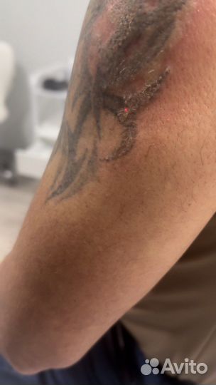 Удаление татуировок и татуажа