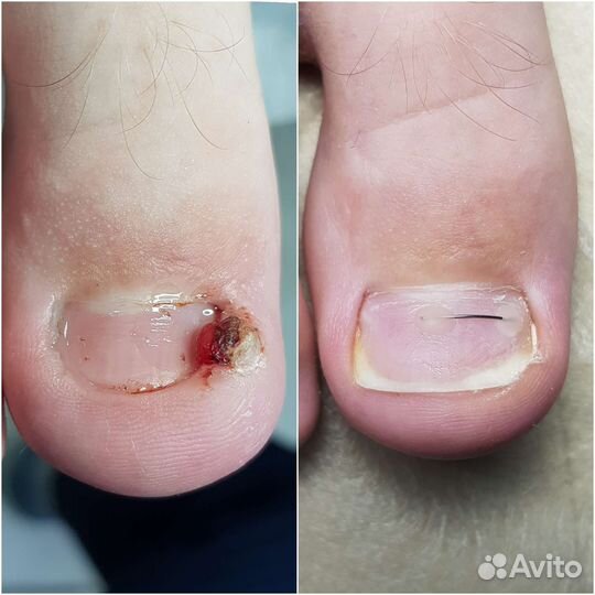 Подолог. Вросший ноготь / медицинский педикюр