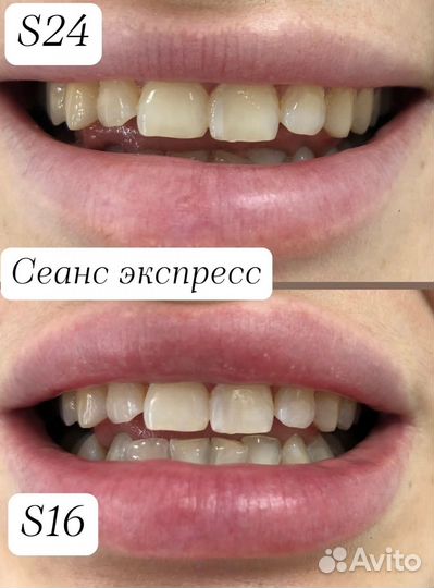 Отбеливание зубов