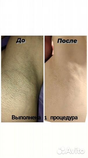 Лазерная эпиляция