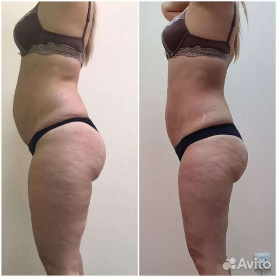 LPG массаж на самом мощном аппарате