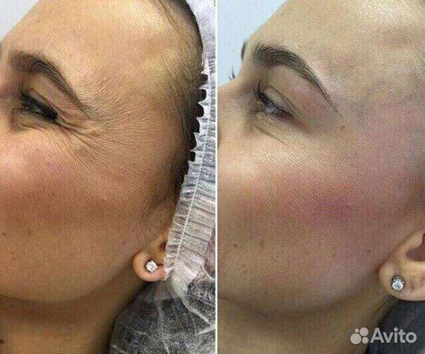 Ботокс верхняя треть