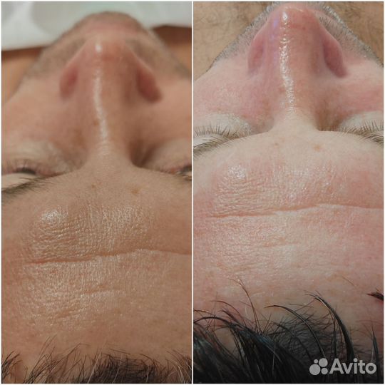 Пилинг Модильяни для лица