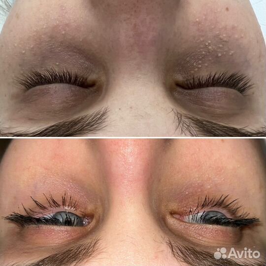 Милиум/Белые угри/Чистка