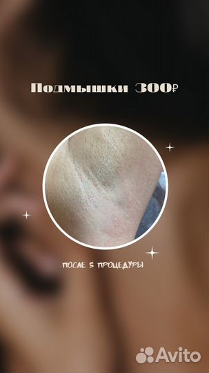 Элос-эпиляция: глубокое бикини