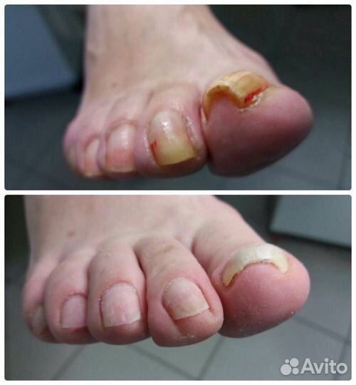 Педикюр любой сложности с подологическим уклоном