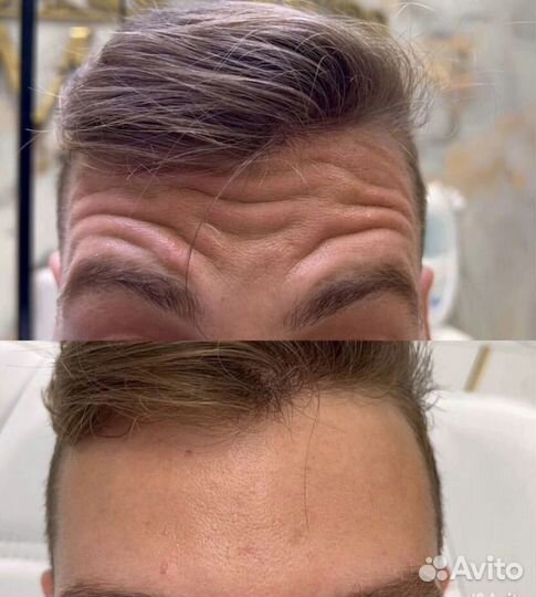 Ботокс для лица и тела/ Фулл Фейс