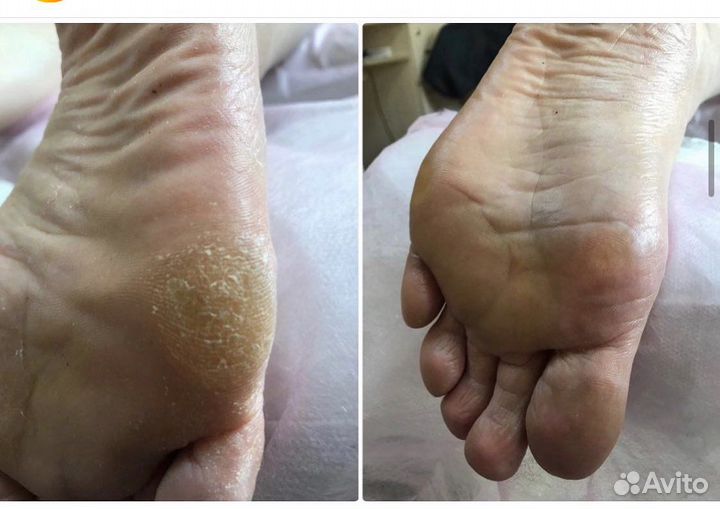 Педикюр, покрытие на ногах