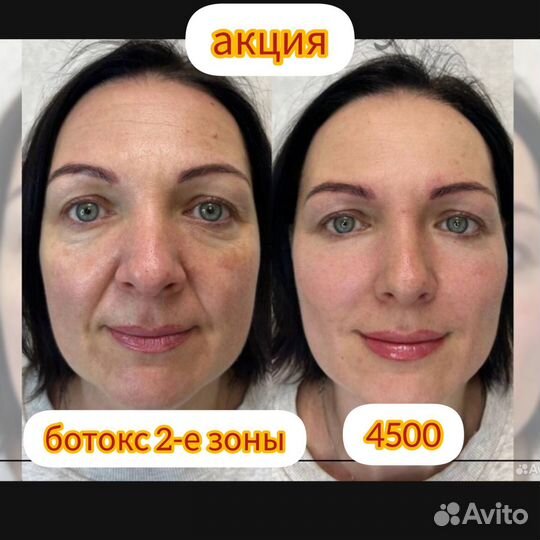 Модели ботокс, диспорт, от морщин, мимики, био