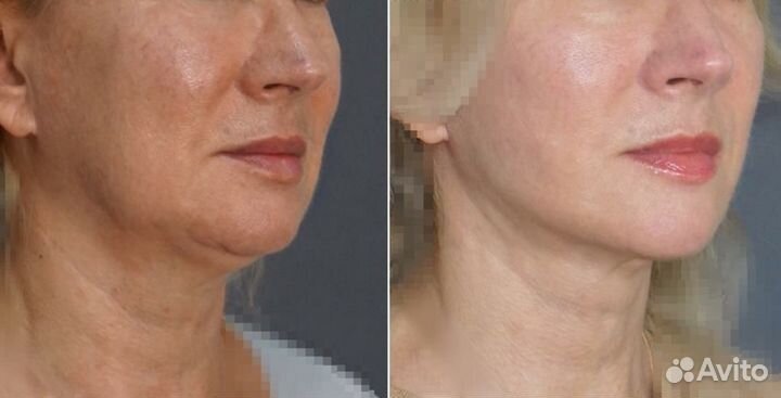 Омоложение Подтяжка лица СМАС лифтинг