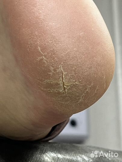 Подолог(вросший ноготь,трещины,мозоли бородавки)