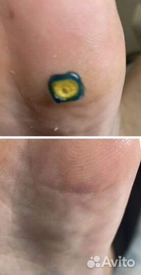 Удаление бородавок