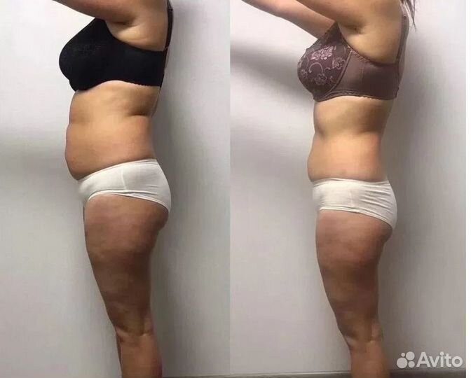 Липосакция без операции в Ростове на Дону