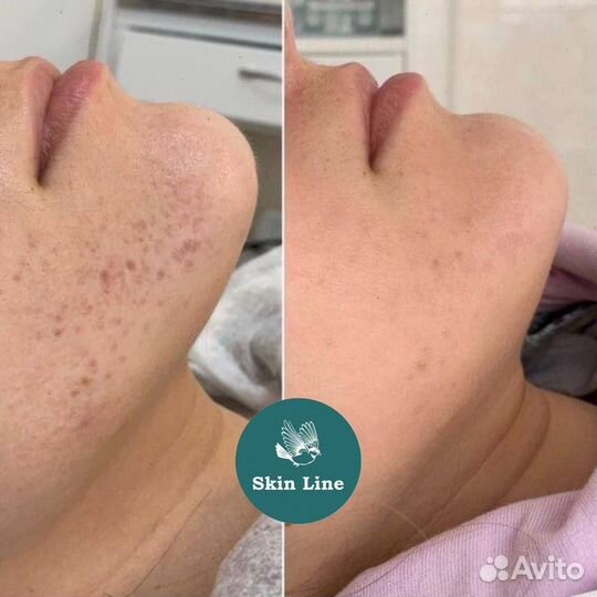 Модели / карбоновый пилинг