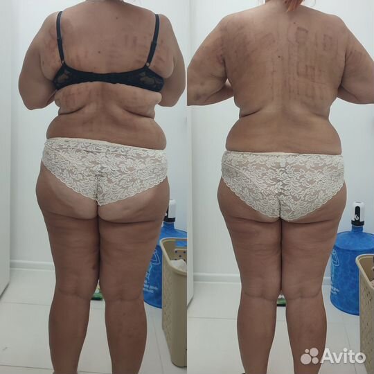 Похудение, Массаж, Аппаратная коррекция фигуры