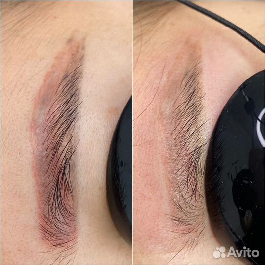 Удаление татуажа, татуировок неодимовым лазером