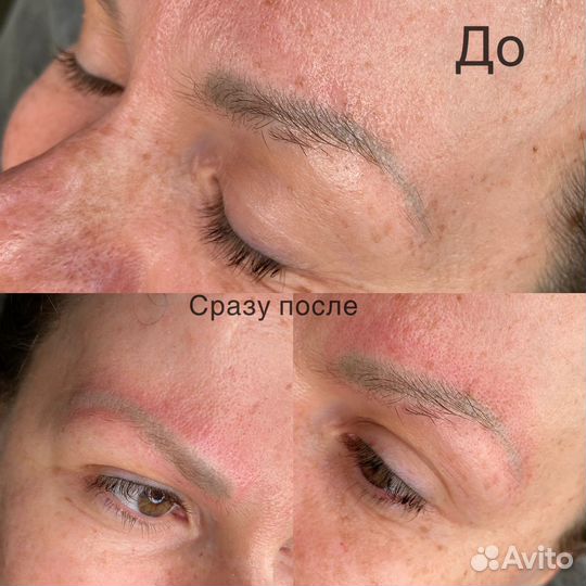 Лазерное удаление тату татуажа