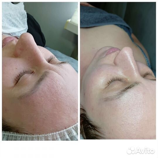 Чистка лица, эстетическая косметология