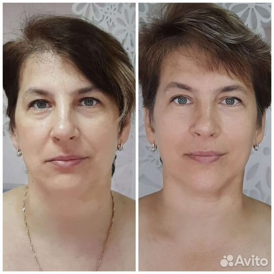Лифтинг лица. Витапластика/Омоложение