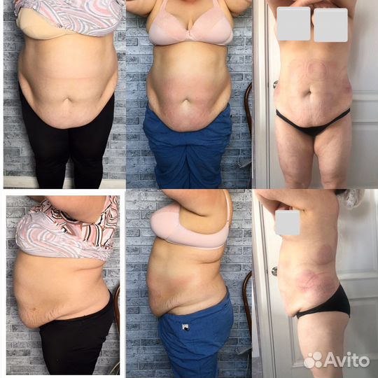 Обучение аппаратным методикам коррекции фигуры