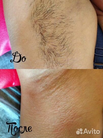 Шугаринг: подмышки