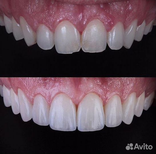 Керамические коронки