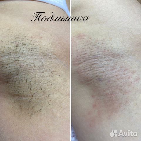 Электроэпиляция: подмышки