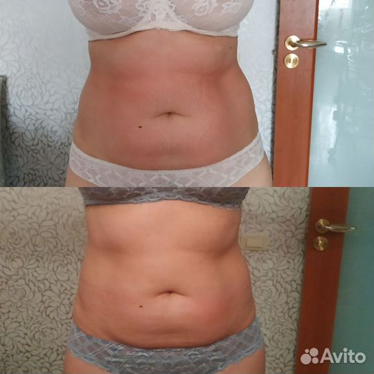 Вакуумный массаж,кавитация