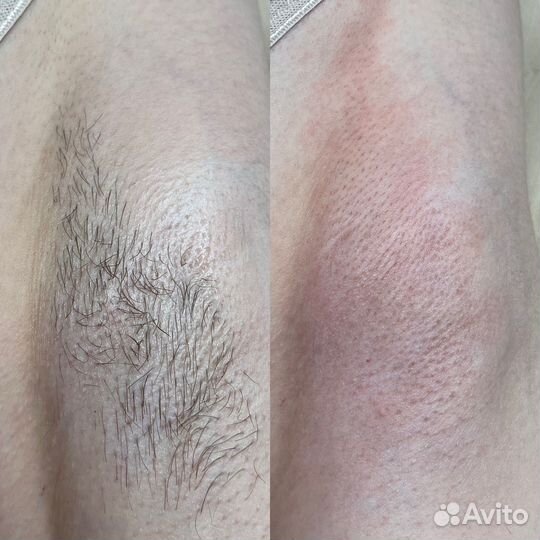 Электроэпиляция