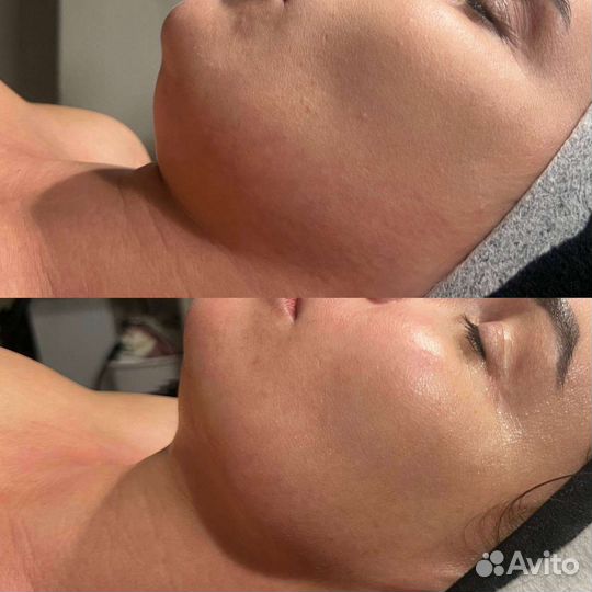 Омоложение кожи лица