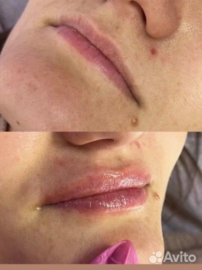 Увеличение губ и другие косметологические услуги