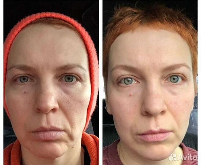 Фейсфитнес/Массаж лица/Фейслифтинг/Тренер/Пилатес