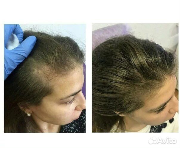 Мезотерапия для кожи головы и волос