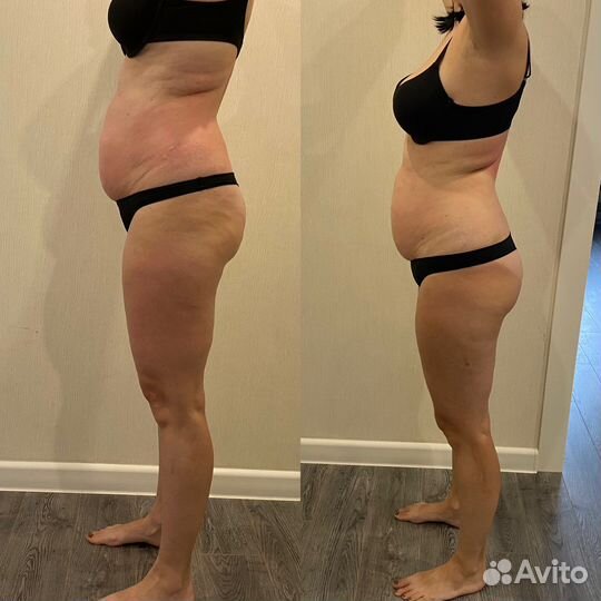 Антицеллюлитный массаж, коррекция фигуры