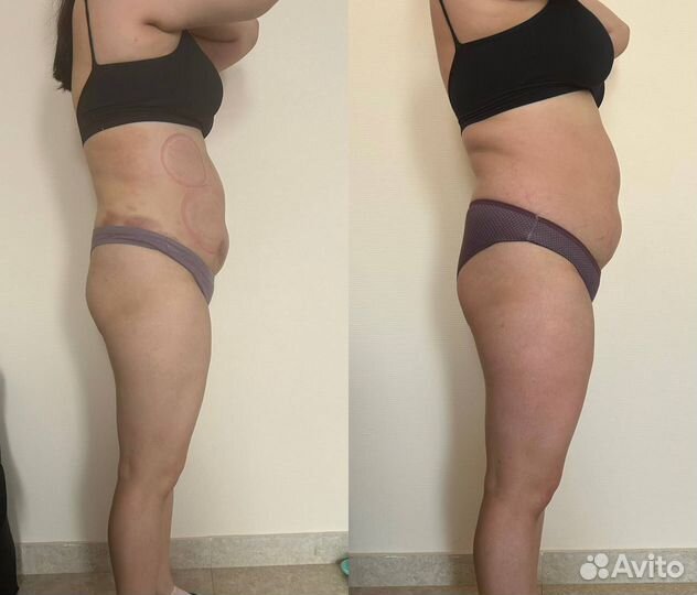 Аппаратный массаж