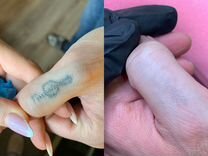 Лазерное удаление татуажа и тату