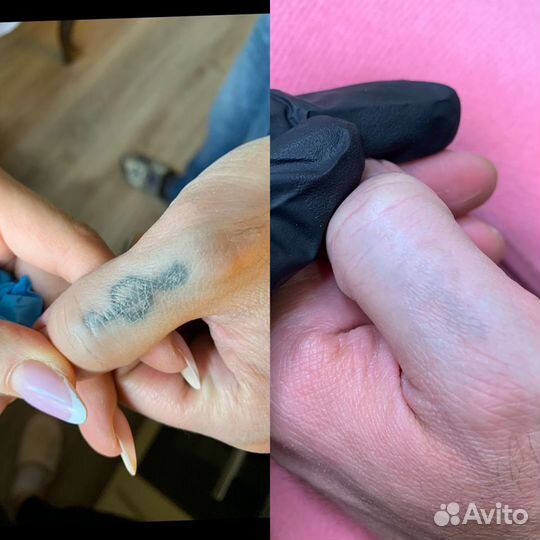 Лазерное удаление татуажа и тату