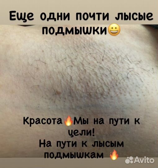 Электроэпиляция