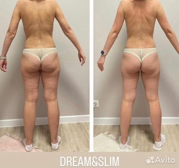 LPG массаж тела