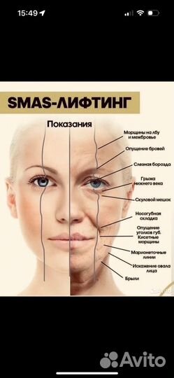 Модель на smas-лифтинг